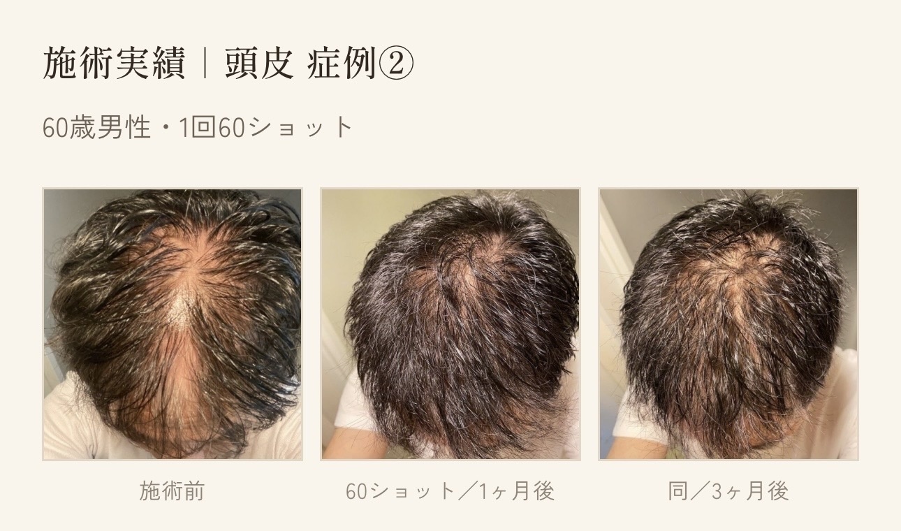 60歳男性の頭皮ケア施術実績 60ショットの経過記録